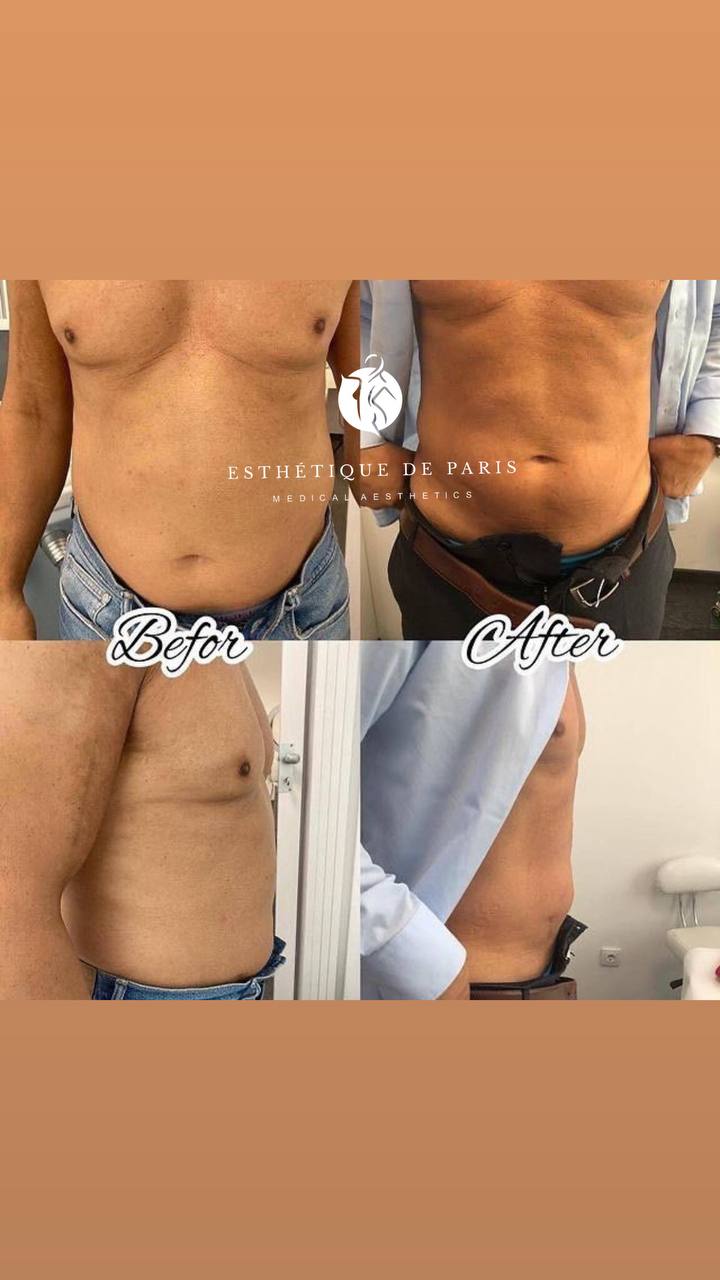 🔵#فروش
   🏙شهر: کلن ، آلمان
   توضیحات: 🔵#فروش
🏙شهر: کلن ، آلمان
توضیحات: بهترین روش لاغری EMS Body Sculpting 
✅ فرم‌دهی به شکم، پهلو و ران
✅ کاهش سلولیت
✅ تقویت عضلات بدون باشگاه
✅ فقط در 30  دقیقه یا ۱ ساعت در هفته
‏📍 Köln langel 
+4917641929631

   👤 ارتباط با شخص |
@hamshahri_alman
صفحه پذیرنده و کاربر آگهی 