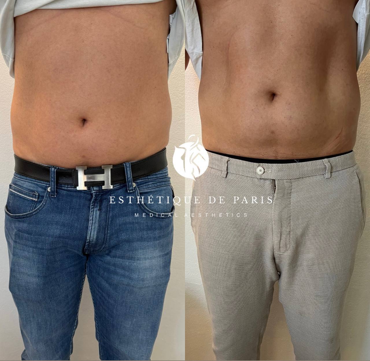 🔵#فروش
   🏙شهر: کلن ، آلمان
   توضیحات: بهترین روش لاغری EMS Body Sculpting 
✅ فرم‌دهی به شکم، پهلو و ران
✅ کاهش سلولیت
✅ تقویت عضلات بدون باشگاه
✅ فقط در 30  دقیقه یا ۱ ساعت در هفته
‏📍 Köln langel 
+4917641929631

   👤 ارتباط با شخص |
@hamshahri_alman